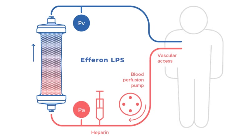 Efferon recibió la aprovación europea para distribuir un nuevo tratamiento para la sepsis en niños. (Efferon)