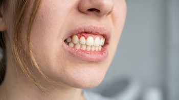Primer plano de la mitad inferior de un rostro mostrando boca ligeramente abierta con encías rojas e inflamadas, dientes blancos y labios secos, sobre fondo gris.