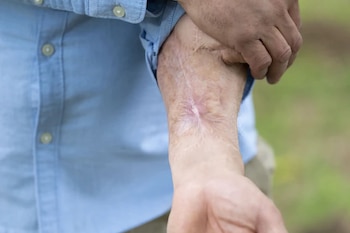 “Un dia se puso negro y se cayó, yo lo boté a la basura”: Perdió su pene por la sepsis y le hicieron uno nuevo que cargó seis años en el brazo