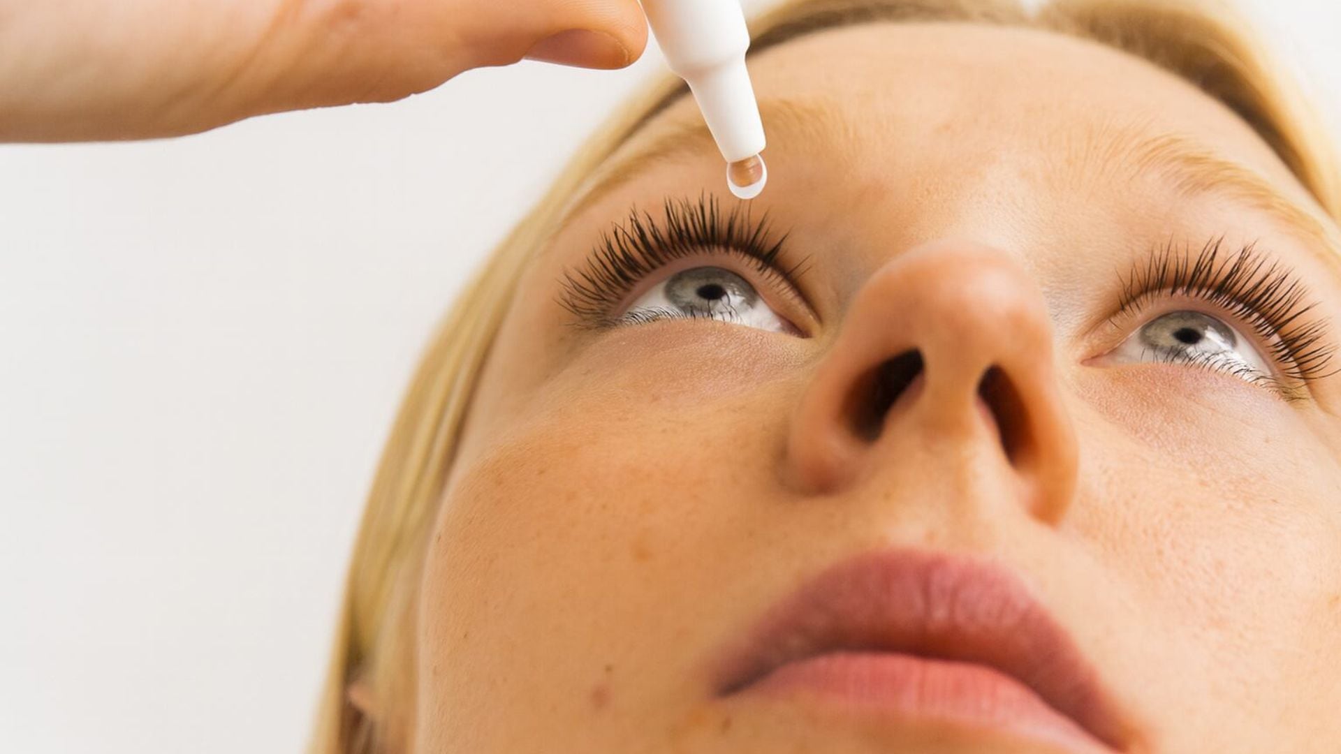 La blefaritis provoca inflamación y enrojecimiento de los párpados, generando dolor y acumulación de costras en las pestañas al despertar