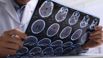 Apagar una proteína vinculada al