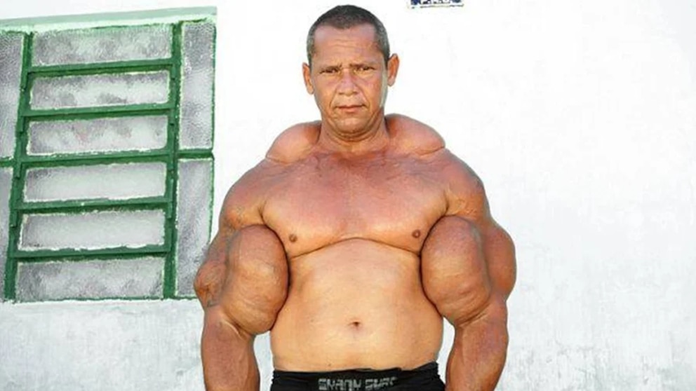 Murió “Popeye”, el fisicoculturista brasileño que se inyectaba aceite para tener unos bíceps de 73 centímetros Murió “Popeye”, el fisicoculturista brasileño que se inyectaba aceite para tener unos bíceps de 73 centímetros