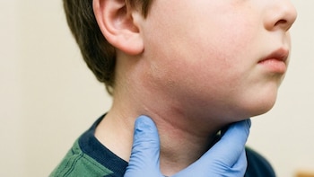 El Ministerio de Salud confirma aumento de paperas en El Salvador