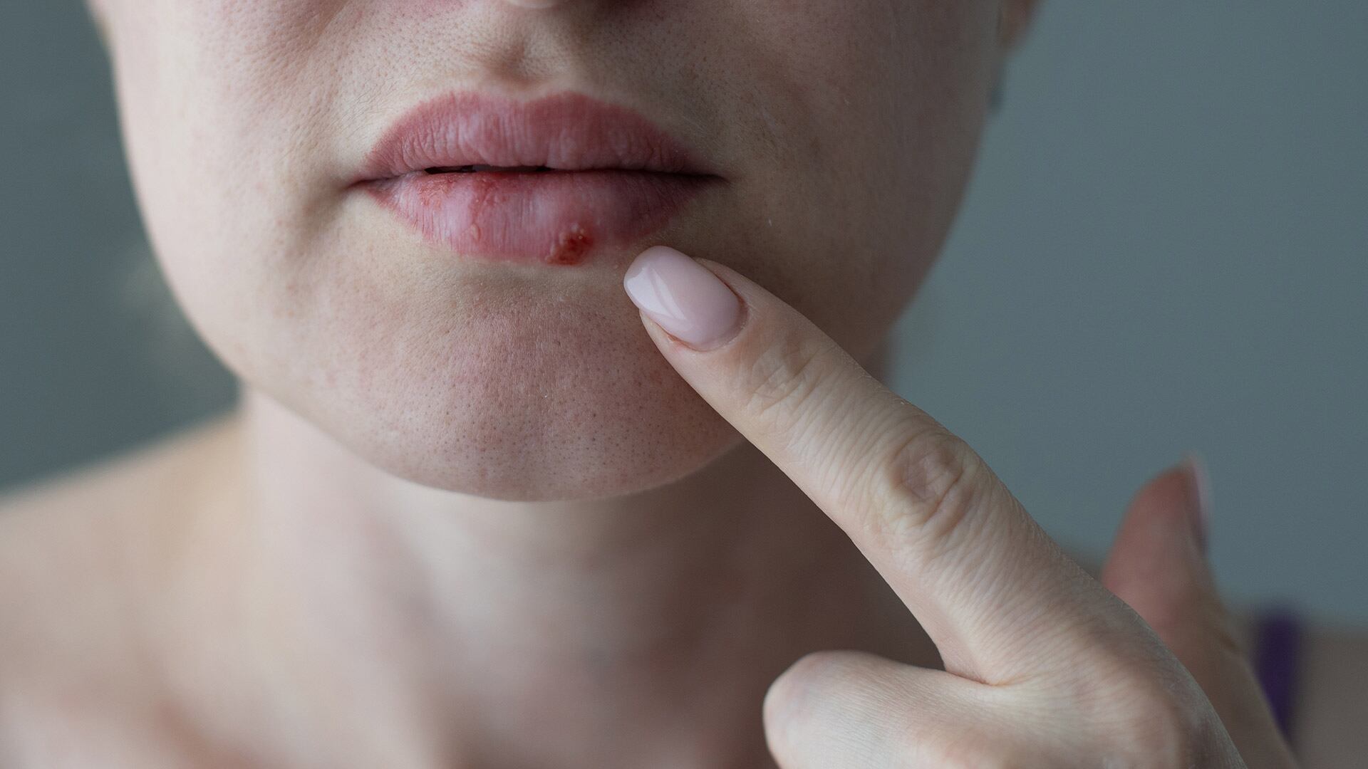El herpes labial recurrente se activa por factores como el descanso insuficiente, el clima extremo y los procedimientos estéticos en los labios (Freepik)