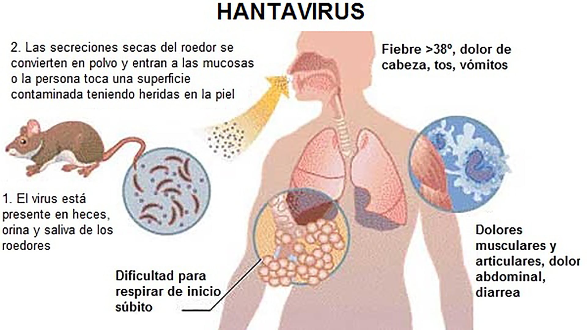 El hantavirus se transmite por inhalación de excreciones de roedores infectados, especialmente en áreas rurales y silvestres