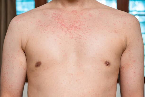 Foto de archivo para ilustrar: En algunos casos los médicos sugieren aislamiento en casa bajo vigilancia constante. Foto: (iStock)