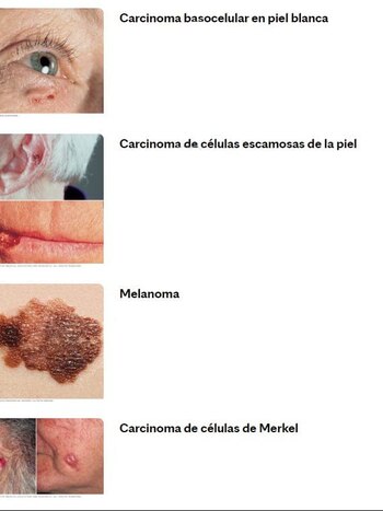 Hay cuatro tipos de cáncer de piel con mayor prevalencia (Clinic Mayo).