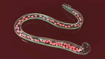 La filariasis, también llamada enfermedad