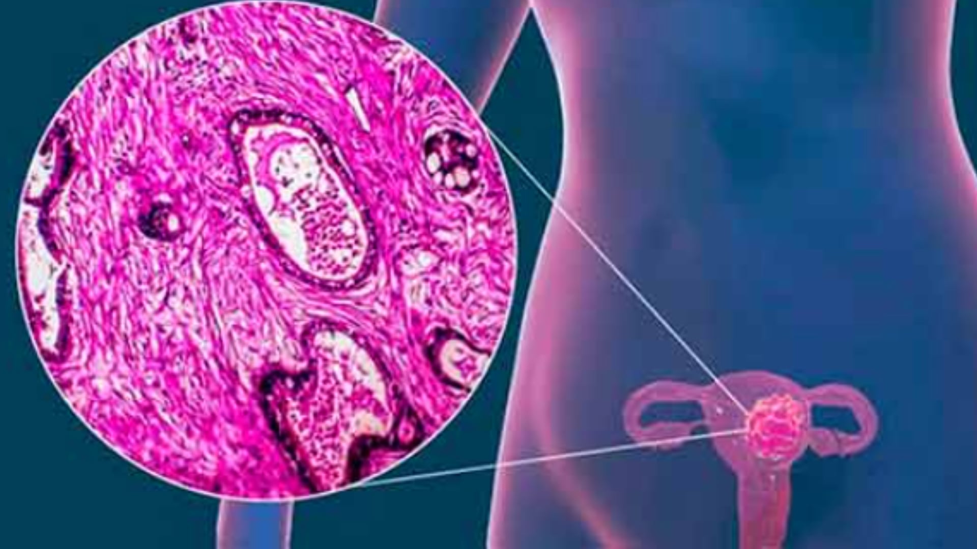 El cáncer cervicouterino puede desarrollarse debido al Virus del Papiloma humano y otros factores modificables como el consumo de tabaco. (UNAM).