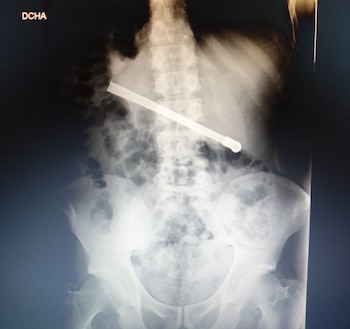 La placa radiográfica que develó