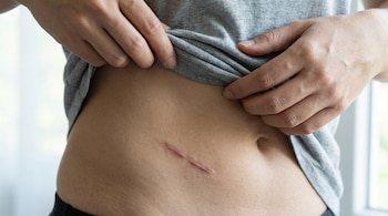 Primer plano del torso de una persona, cuyas manos levantan una camiseta gris para revelar una cicatriz rosada en diagonal en el abdomen.