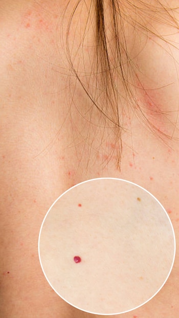 Los puntos rubí son pequeñas