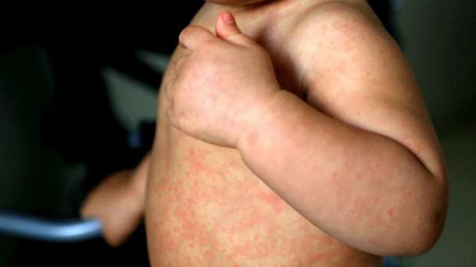 Argentina mantiene el estatus de eliminación de circulación endémica de sarampión desde 2000, pero enfrenta brotes importados por falta de vacunación (OPS)