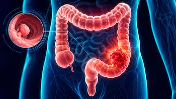 Colonoscopia: cómo es la prueba que puede detectar y eliminar el cáncer colorrectal en el mismo procedimiento