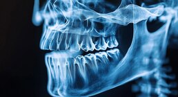 Qué es la gingivitis y por qué representa una amenaza silenciosa para la salud bucodental