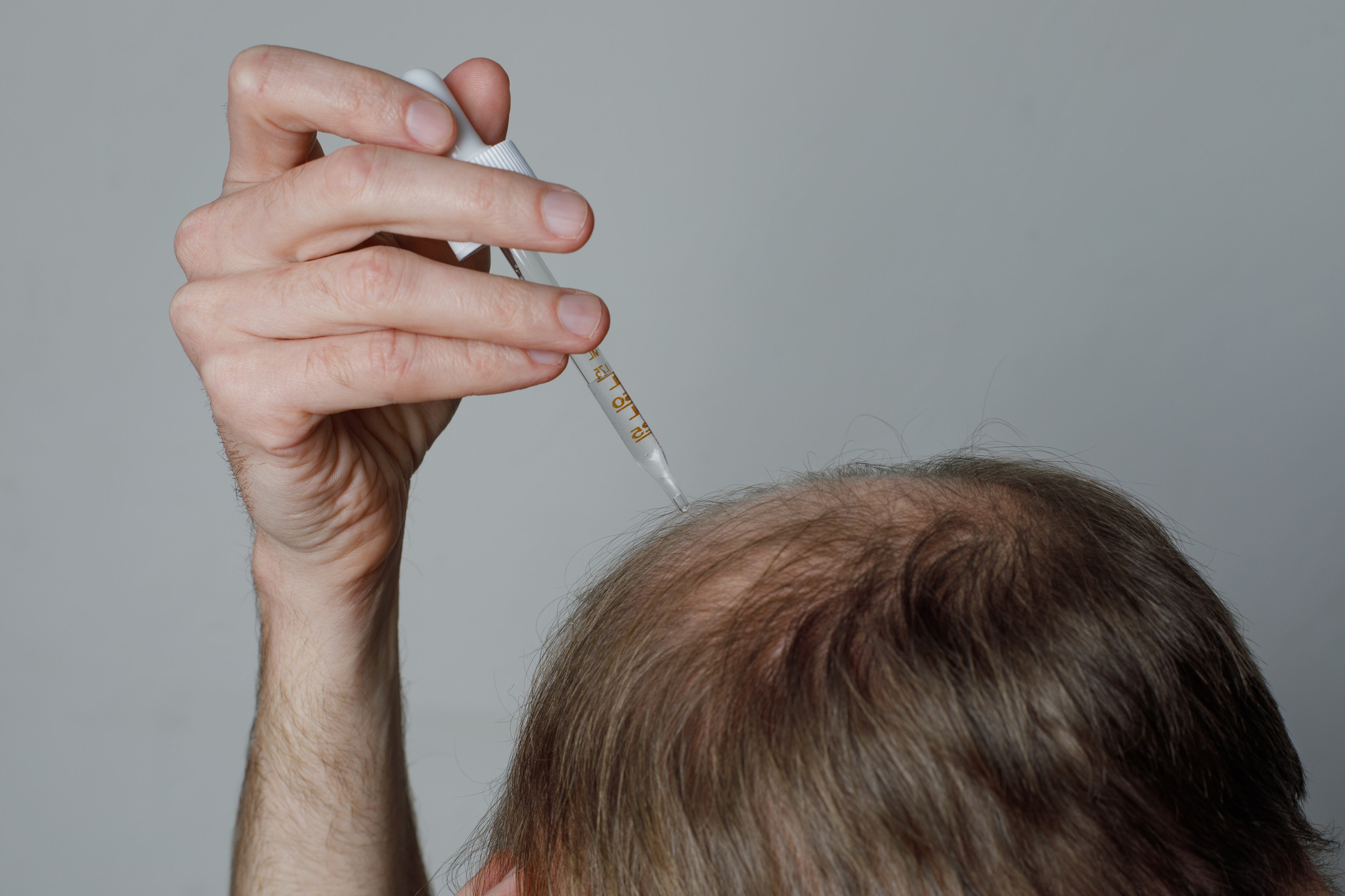 El minoxidil, tanto tópico como oral, es uno de los tratamientos más eficaces y respaldados científicamente para estimular el crecimiento capilar (AdobeStock)