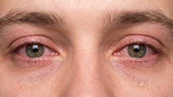 ¿Ojos irritados, ardor y enrojecimiento? Así puedes saber si padeces síndrome de ojo seco