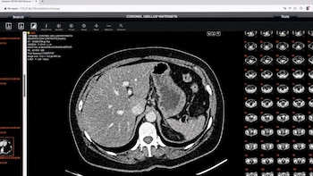 El tumor cancerígeno alcanzó los 40 centímetros de tamaño, pesó cerca de dos kilos y comprometió órganos vitales como el bazo, el riñón izquierdo, el páncreas y el colon descendente - Créditos: Essalud.
