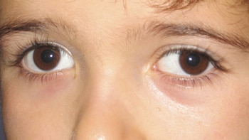 El estrabismo puede ser un