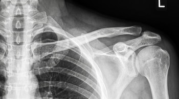 Una radiografía médica en escala de grises que muestra la clavícula izquierda, el hueso del hombro, costillas superiores y vértebras.