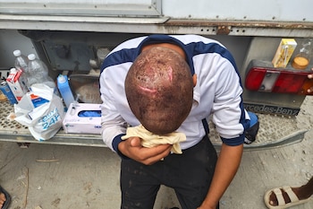 Un migrante en Ceuta muestra sus heridas, agredido por militares españoles, según Amnistía Internacional. (EFE/AI)