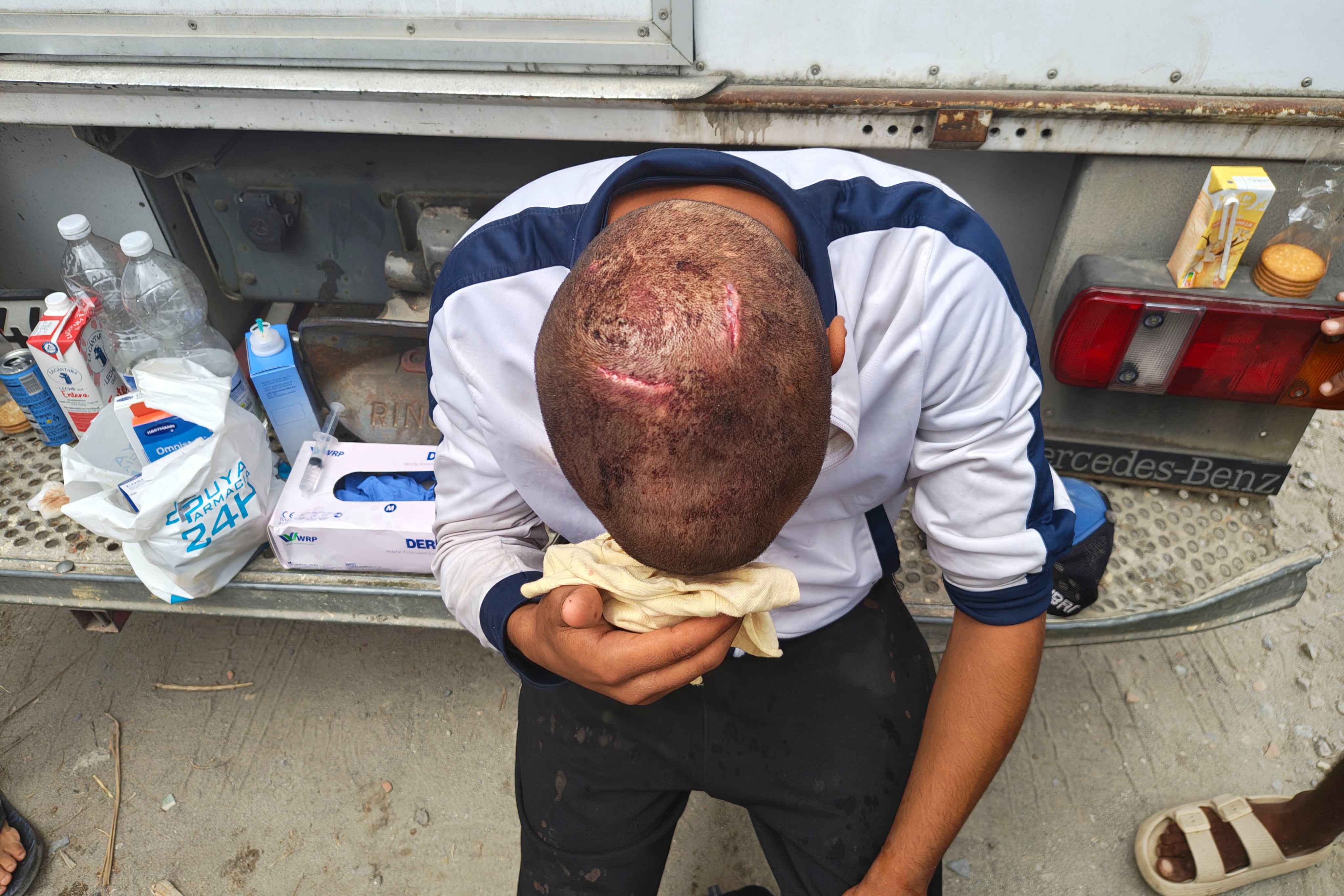 Un migrante en Ceuta muestra sus heridas, agredido por militares españoles, según Amnistía Internacional. (EFE/AI)