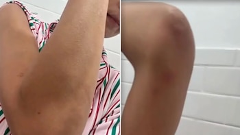 Dos imágenes yuxtapuestas muestran un brazo flexionado y una pierna con marcas en la piel sobre un fondo de azulejos blancos