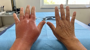 Primer plano de dos manos sobre una mesa de examen azul; una mano está muy hinchada y roja por angioedema, la otra es normal, con equipo médico al fondo.
