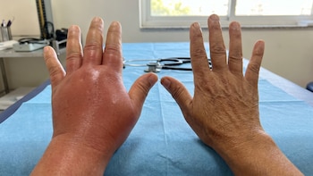 Angioedema hereditario: claves para detectar los síntomas y evitar diagnósticos erróneos