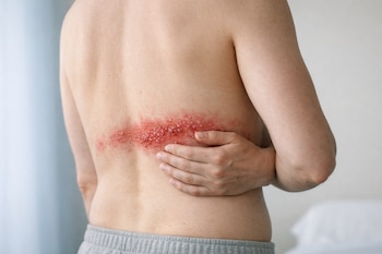 Torso de un adulto de espaldas con una banda de piel enrojecida y ampollas en la zona lumbar. Una mano toca suavemente la erupción cutánea.