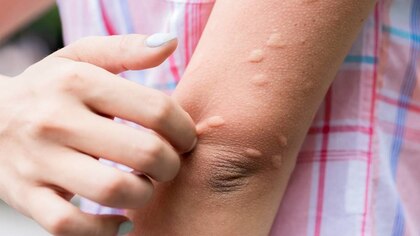 Estas son las alergias más raras y poco comunes del mundo