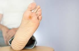 El pie diabético se produce cuando hay un mal control de la glucosa en la sangre.Foto: Clinicas Cuidate
