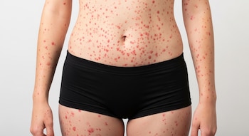 Primer plano del torso de una persona mostrando una erupción de pequeñas manchas rojas en el abdomen, brazos y parte superior de las piernas.