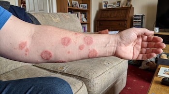 Un brazo humano con múltiples lesiones cutáneas circulares de eccema numular. Se observa la mano y parte del torso con camiseta azul, y un sofá al fondo.