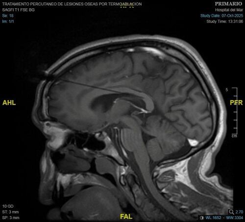 TAC de una callosotomía (Hospital del Mar de Barcelona)
