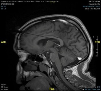 TAC de una callosotomía (Hospital