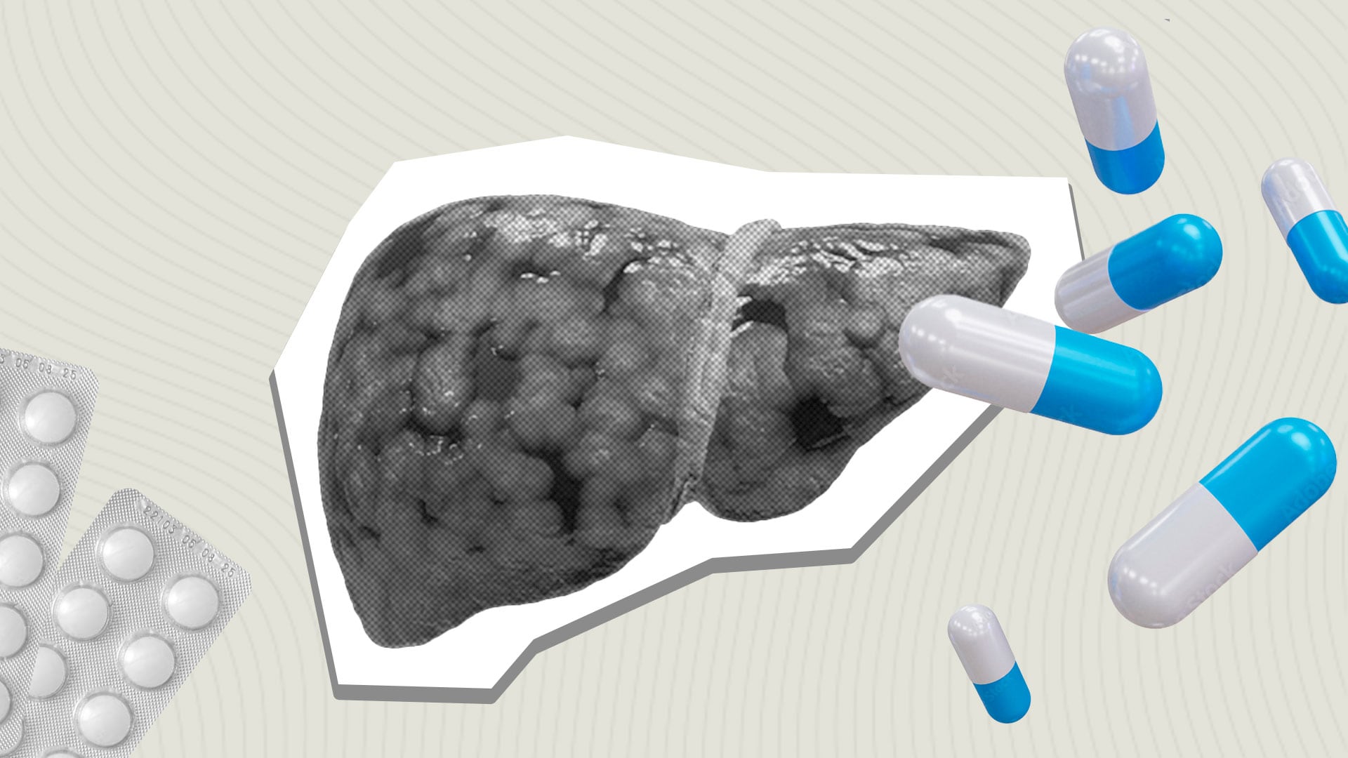 Cuáles son los medicamentos que pueden provocar hígado graso de forma forma silenciosa o sin síntomas(Foto: Infobae México/ Jovani Pérez)