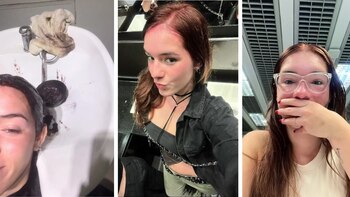 Virales- reacción alérgica con la tintura