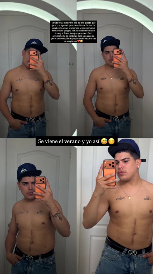 “Sé que estas cicatrices son de una guerra que gané porque sigo acá, pero también me da mucha vergüenza andar sin remera y no sé qué hacer”, se lamentó Thiago Medina (Instagram)