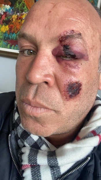 Accidente de Wanderlei Silva ex UFC