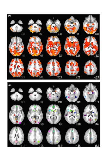 Comparación de las resonancias magnéticas