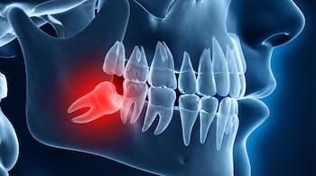Ilustración 3D translúcida de una mandíbula humana con dientes visibles, mostrando una muela del juicio inferior resaltada en rojo.