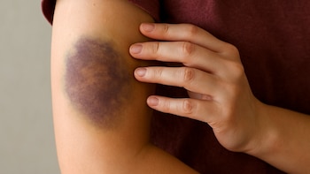 La deficiencia de vitamina C