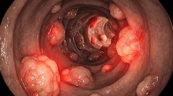 Imagen médica que muestra una vista ampliada del interior de un colon con numerosas formaciones de tejido de color rosado y rojizo, indicando pólipos o tumores.