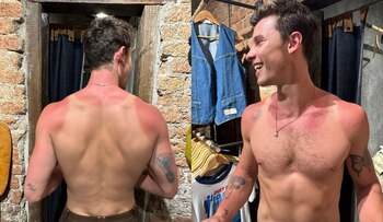 Shawn Mendes presumió sus quemaduras