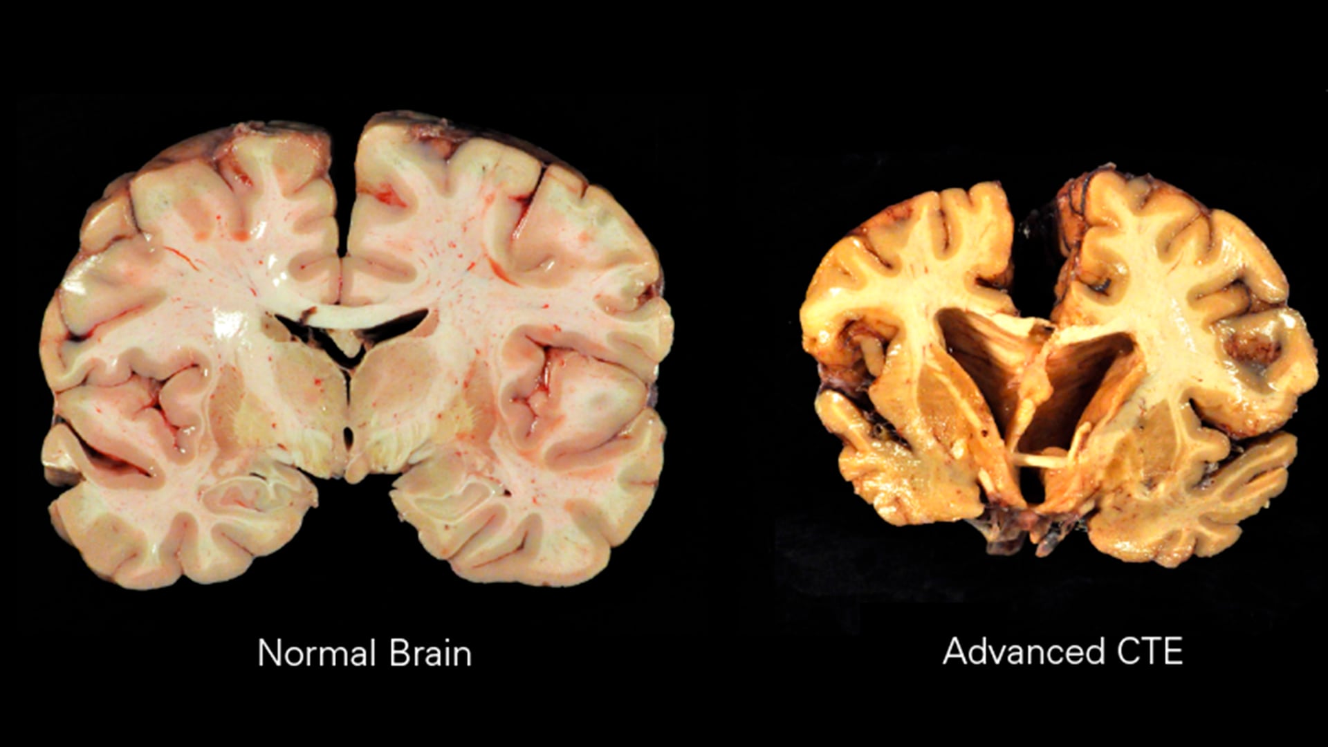 La encefalopatía traumática crónica solo puede diagnosticarse de forma definitiva después de la muerte mediante el análisis del tejido cerebral (Wikipedia)
