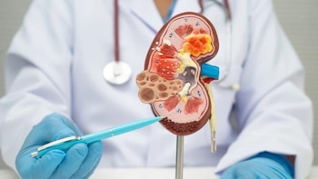 Un estudio alerta del avance de la enfermedad renal crónica entre las mujeres