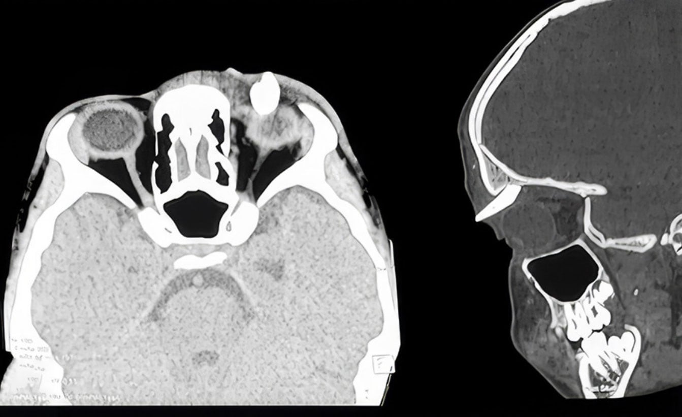 Un adolescente de 16 años fue operado en India tras detectar un diente dentro de la órbita izquierda (Academia Estadounidense de Oftalmología)