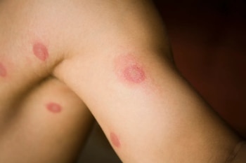 Infecciones por TMVII responden a terapias antifúngicas estándar como terbinafina y Lamisil. (Getty Images)