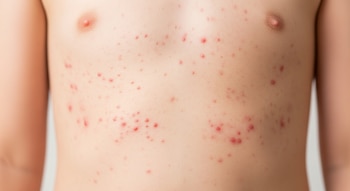 Primer plano del torso de un niño o adulto joven, mostrando múltiples erupciones cutáneas rojas distribuidas irregularmente sobre la piel.